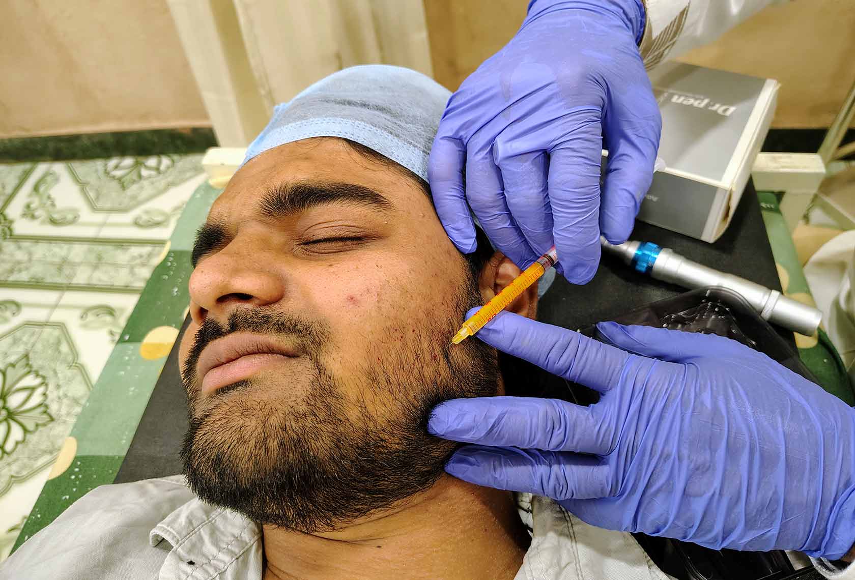 Beard-PRP-Hair-Regrowth-Treatment-2