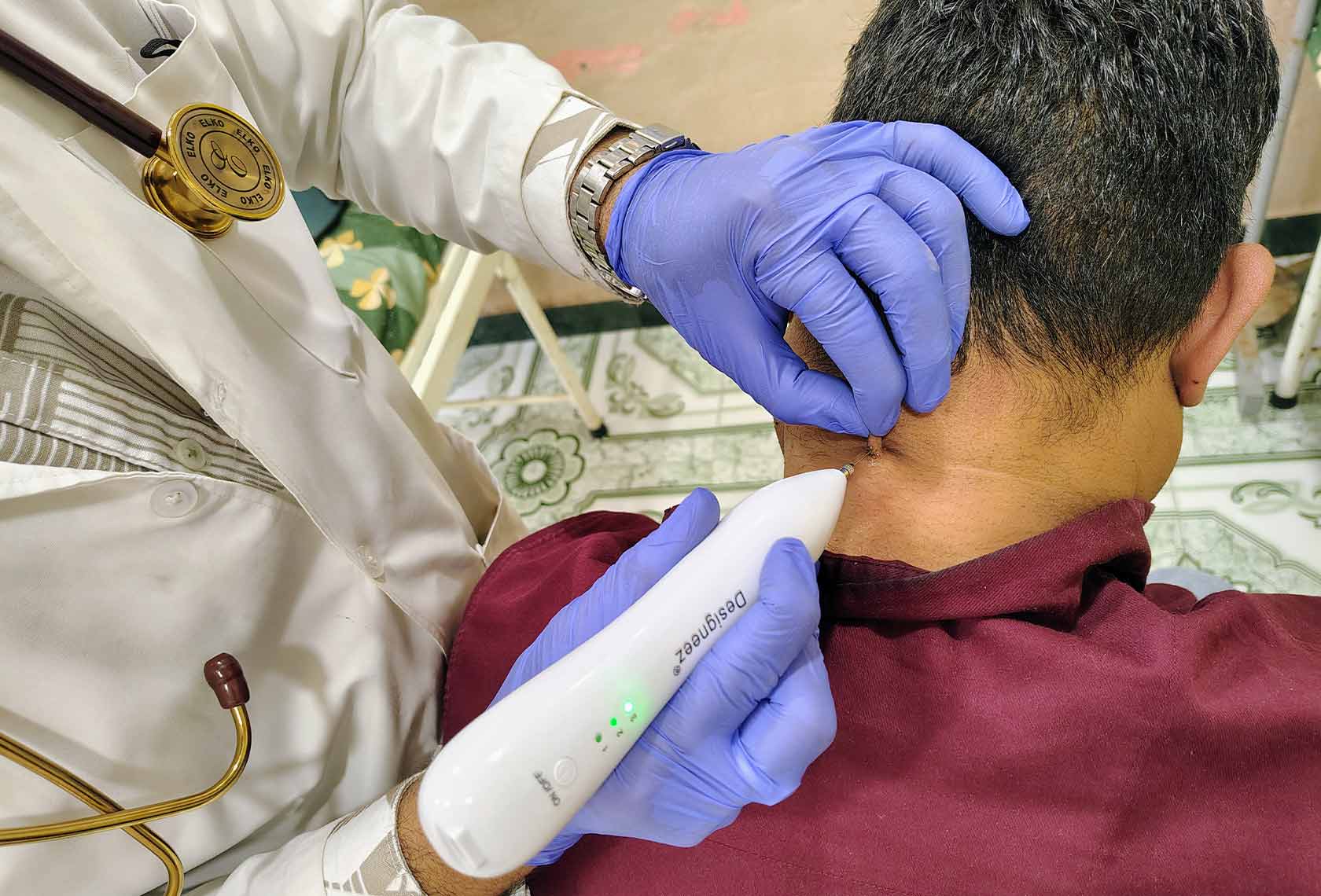 Cryotherapy-Treatment-for-Warts-2