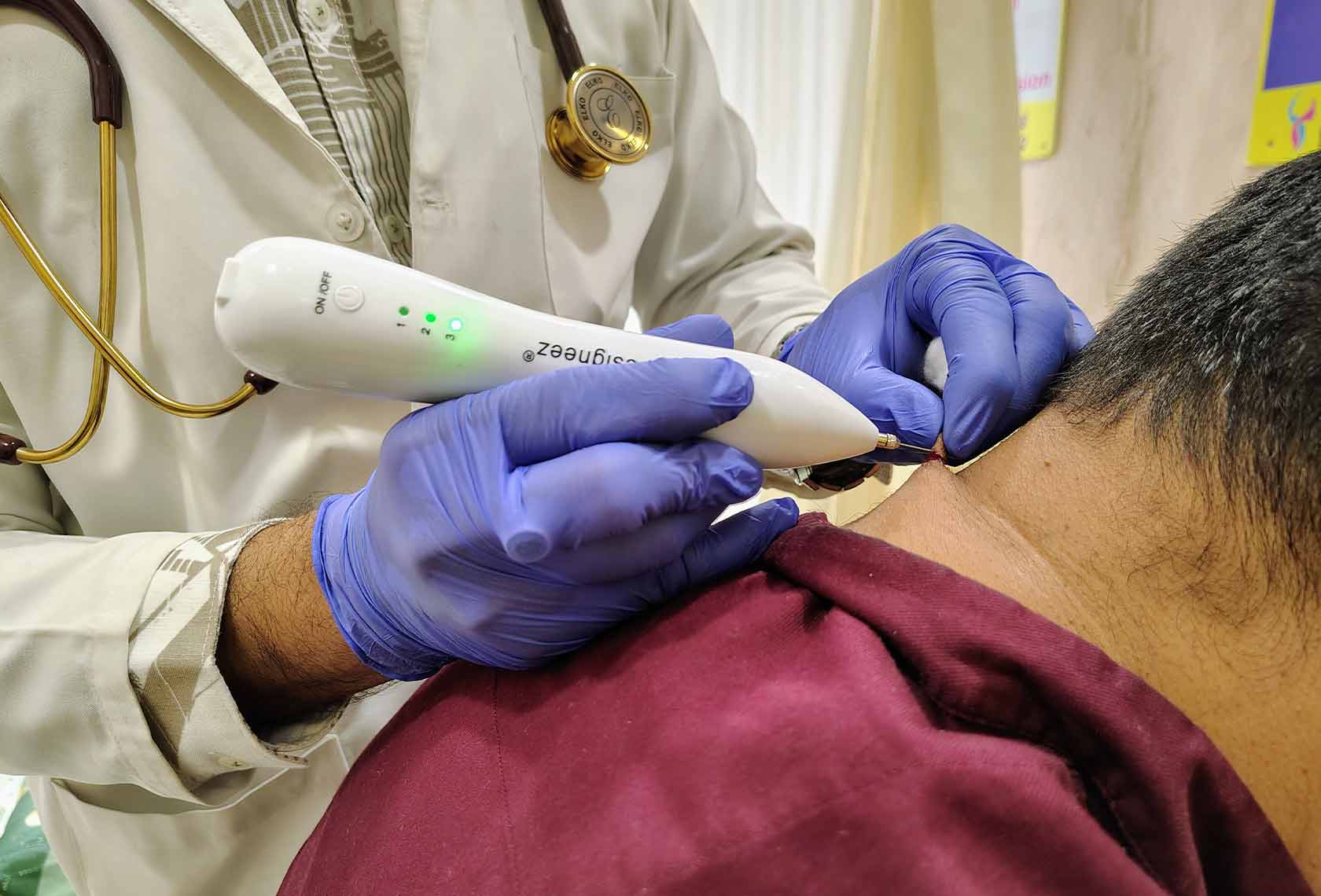 Cryotherapy-Treatment-for-Warts-3