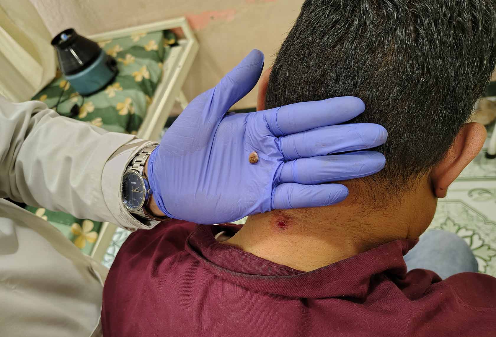 Cryotherapy-Treatment-for-Warts-4